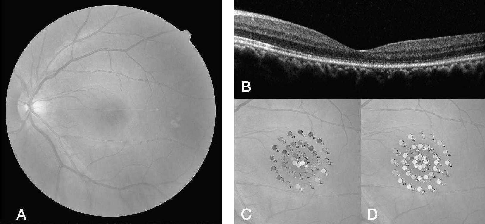 病例2-1-6 诊断:左眼陈旧性CSC。